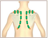 Lapocka körülötti izmok könnyen bekeményednek